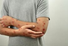 Prevén reforzar vacunación contra el sarampión con módulos del Metro y terminales de autobuses en CDMX